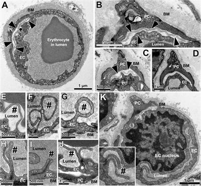 Structural Microangiopathies in Skeletal Muscle Related to Systemic Vascular Pathologies in Humans